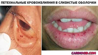 петехиальные кровоизлияния в слизистые