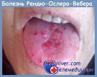 Болезнь Рендю-Ослера-Вебера