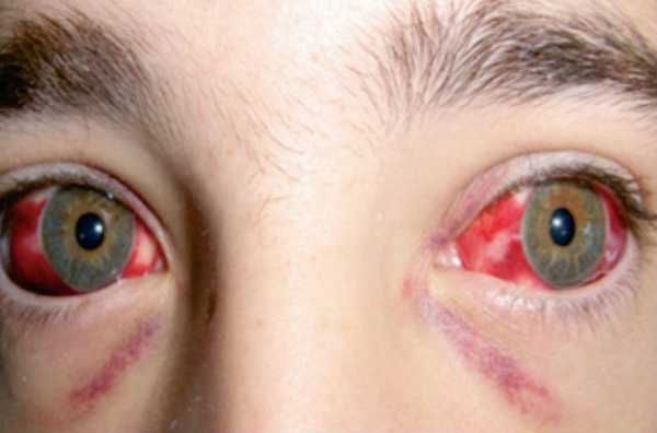 Кровоизлияния в склеру