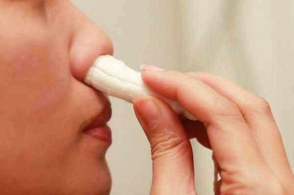 Остановка носового кровотечения