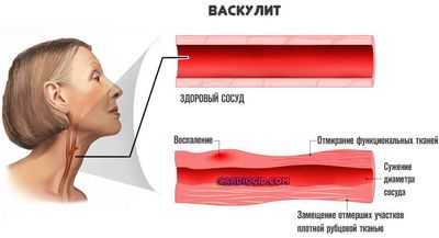 васкулит сонной артерии