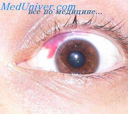 гемморагический диатез