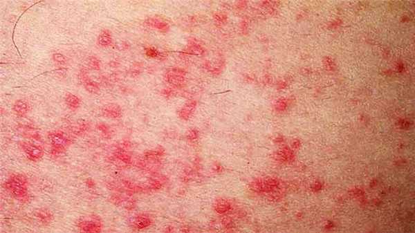Сыпь при васкулите