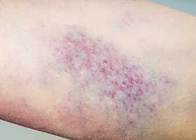 Геморрагический синдром