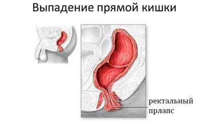 Выпадение прямой кишки