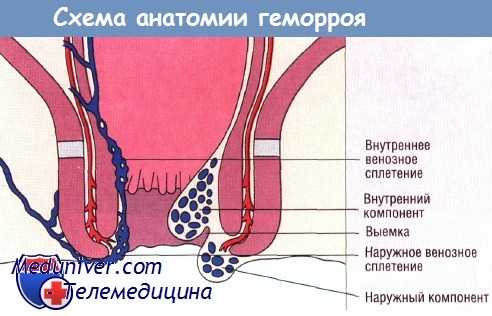 Схема геморроя
