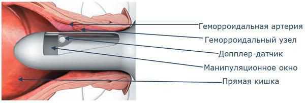 Дезартеризация с лифтингом слизистой