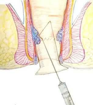 Склерозирование