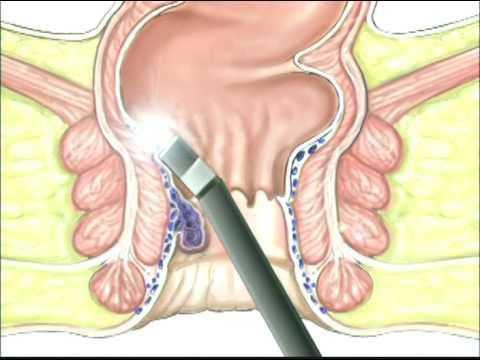 Фотокоагуляция