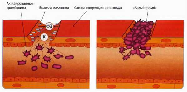 Образование тромба