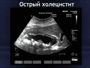 острый холецистит на рентгене