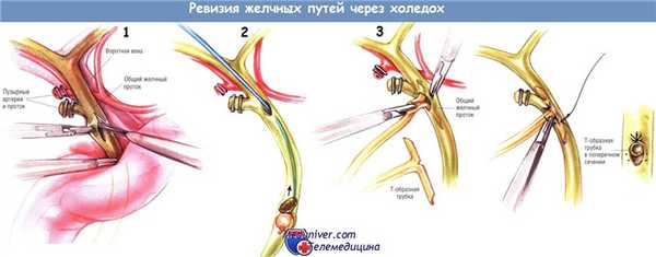 Ревизия желчных путей через холедох