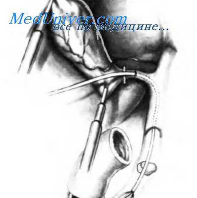 лапароскопическое удаление конкрементов из холедоха