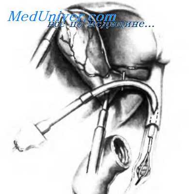 лапароскопическое удаление конкрементов из холедоха