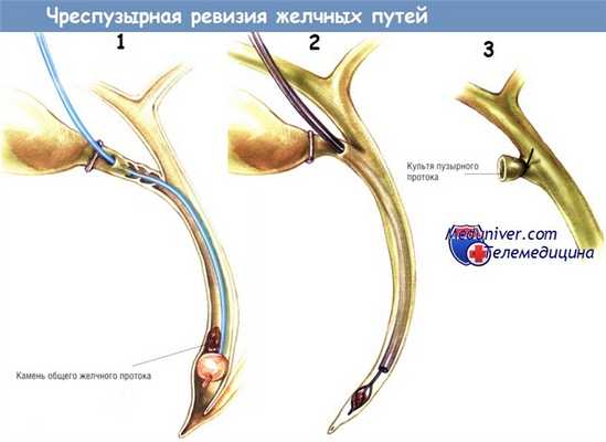 Чреспузырная лапароскопическая ревизия желчных путей