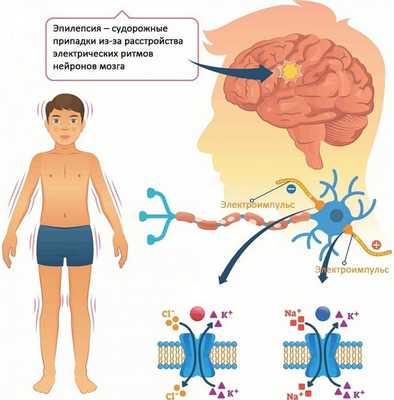 Эпилепсия
