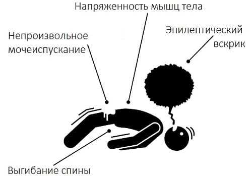 Генерализованная эпилепсия
