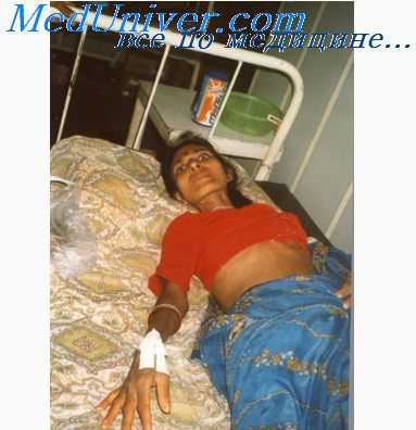 клиника перитонита