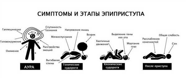 Стадии и особенности эпилептических приступов