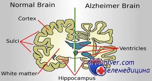 болезнь Альцгеймера