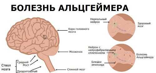 Механизм болезни Альцгеймера