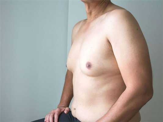 Синдром Клайнфельтера