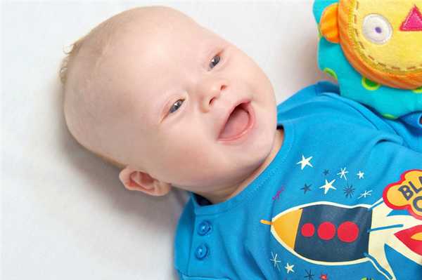 Синдром Дауна