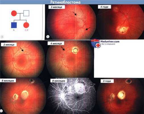 Ретинобластома