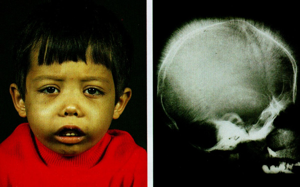 Талассемия