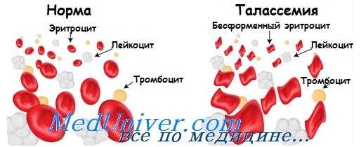 бета-талассемия