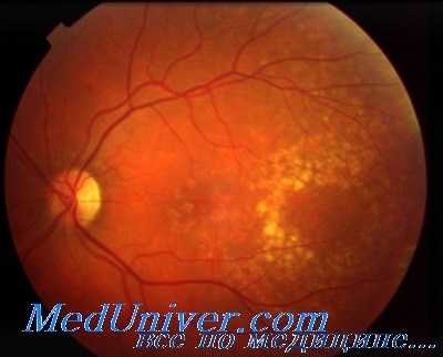 возрастная дегенерация макулы