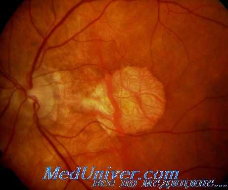 возрастная дегенерация макулы