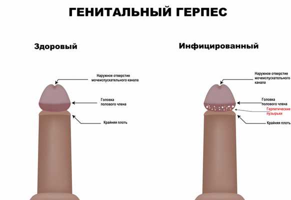 Генитальный герпес 