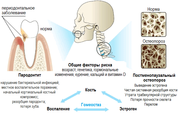 Схематическая иллюстрация связи между пародонтитом и остеопорозом