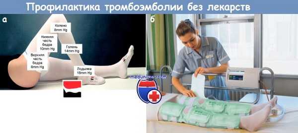 Профилактика тромбоэмболии без лекарств