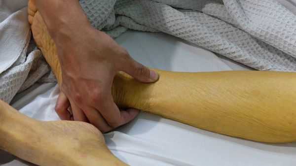 Желтушный период болезни