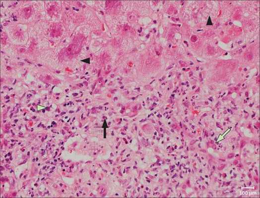 Клетки печени при остром гепатите Е