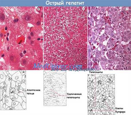 Острый гепатит