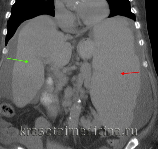 КТ ОБП. Диффузное увеличение печени (зеленая стрелка) и более выраженное увеличение селезенки (красная стрелка).