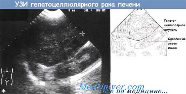 УЗИ гепатоцеллюлярного рака