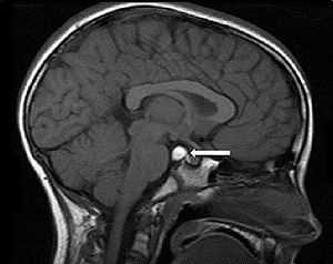 Герминома головного мозга