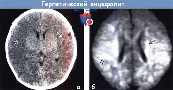 Герпетический энцефалит у новорожденных на КТ, МРТ