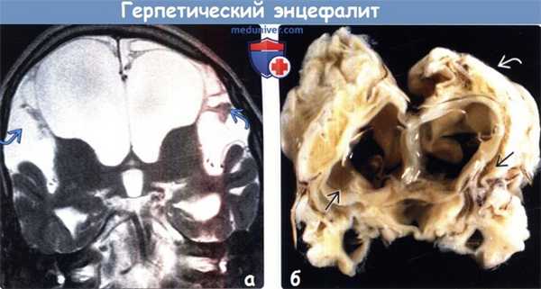 Герпетический энцефалит у новорожденных на МРТ