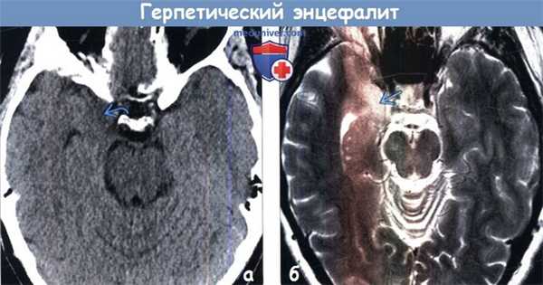 Герпетический энцефалит на КТ, МРТ