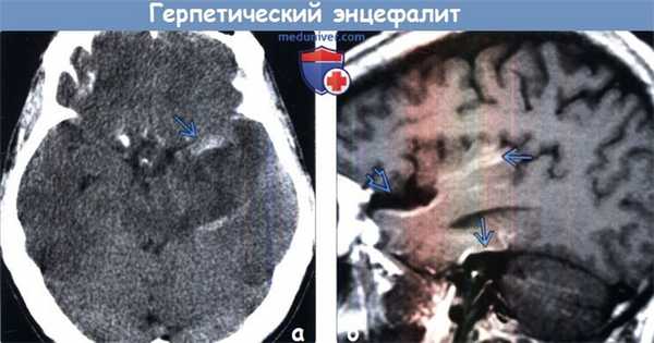 Герпетический энцефалит на КТ, МРТ
