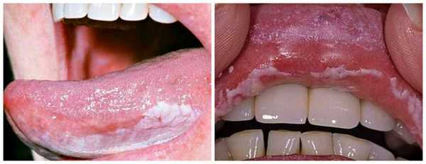 Лейкоплакия