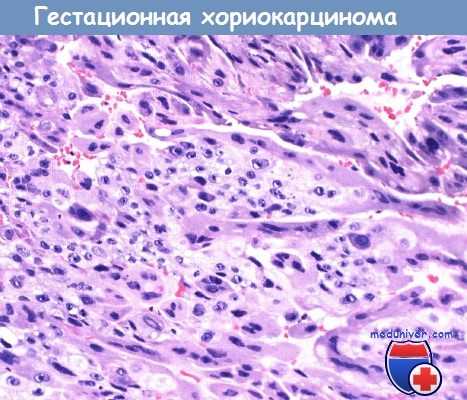 Гестационная хориокарцинома