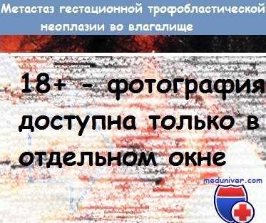 Метастаз гестационной трофобластической неоплазии