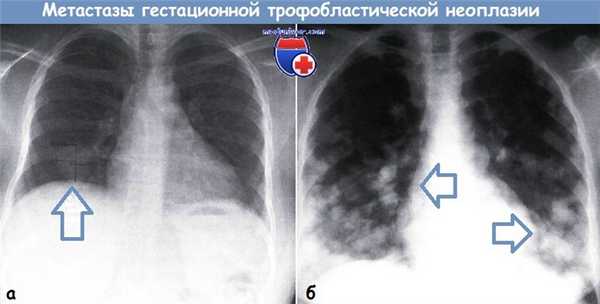 Метастазы гестационной трофобластической неоплазии