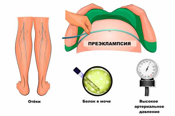Преэклампсия.jpg
